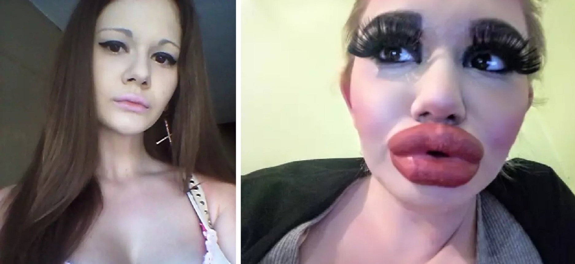 Woman Multiplies The Size Of Her Lips With Injections, Wants Them Even Bigger Now!