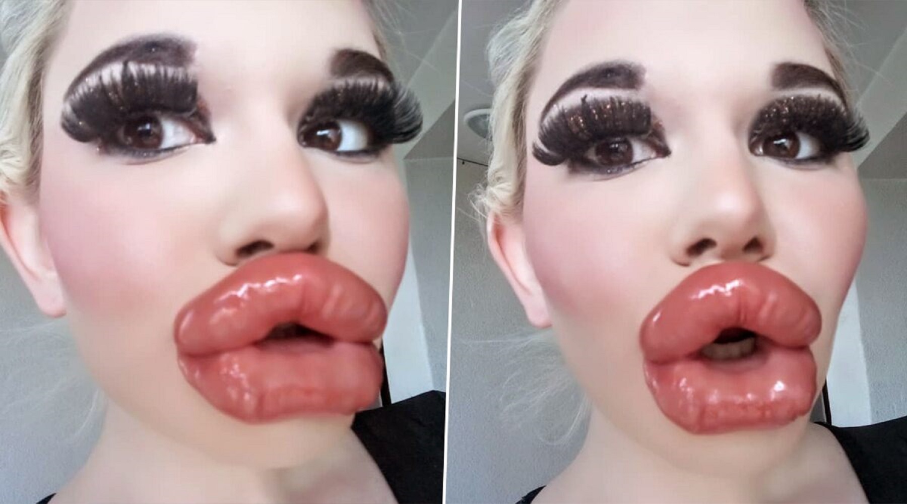 Woman Shows Off Her ‘Post Procedure’ Lips Following 20th Lip Injection